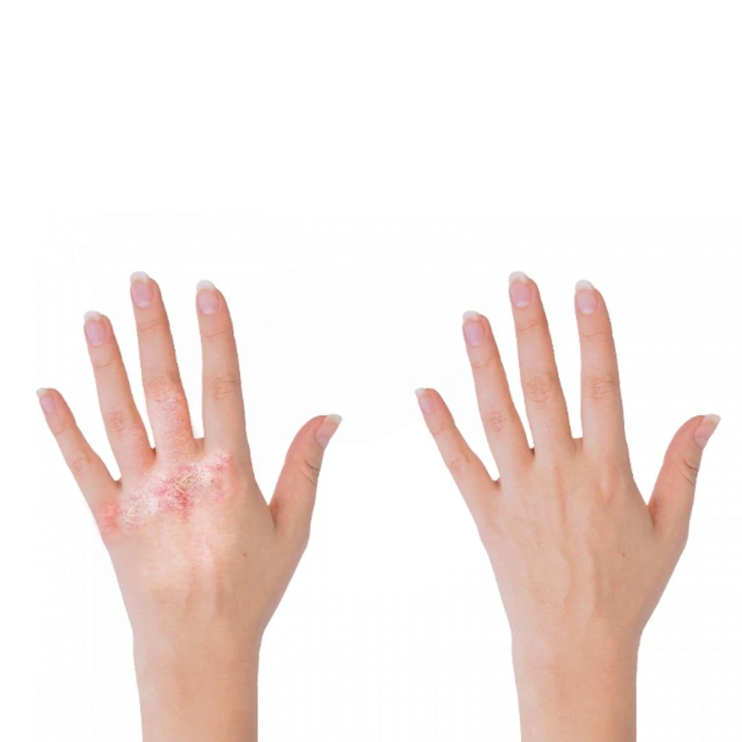 Medimento Balzam za Ruke sa 10% Uree, Maslinovim Uljem i Papajom 60 mL